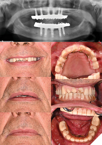 Initial presentation and previous panoramic radiograph of a patient presenting with a fractured Mx IS-FDP opposing Md IS-FDP. 