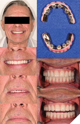 Tooth set-up try-in appointment during retread of Mx and Md IS-FDP at recovered VDO following previous record utilizing the same denture tooth mold and shade. Note that the asymmetric buccal corridor display replicated the initial design and was limited by the existing framework design and cantilever. Patient approved esthetics and gave consent for processing.
