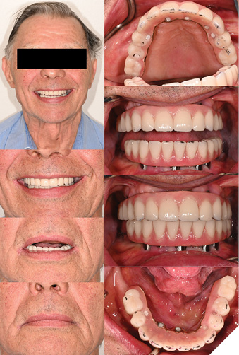  Clinical photos and radiographs of Mx and Md IS-FDP at time of insertion. Occlusal markings visible. Teflon tape with clearbyte material placed as interim restoration over screw access channels, which was replaced with composite at post-insertion visit.