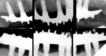  Clinical photos and radiographs of Mx and Md IS-FDP at time of insertion. Occlusal markings visible. Teflon tape with clearbyte material placed as interim restoration over screw access channels, which was replaced with composite at post-insertion visit.