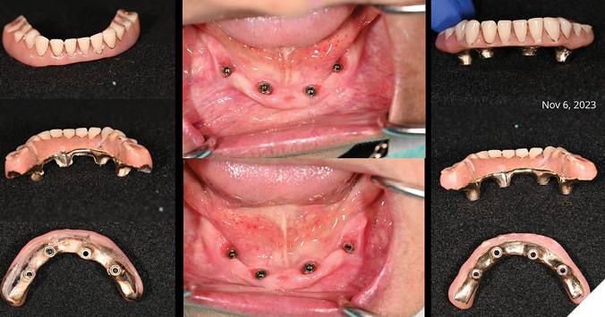 Removal of Md IS-FDP for periodontal therapy and acrylic recontouring to remove flange.