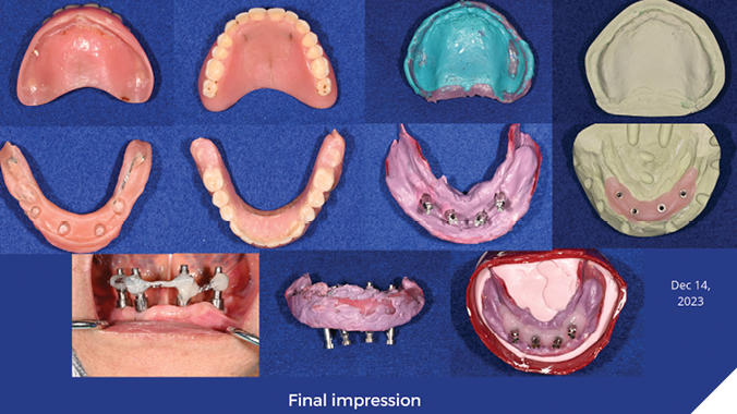 Open-tray final impression and maxillary final impression (polyether border molding, polyvinyl siloxane wash). Master cast with soft tissue mask. 