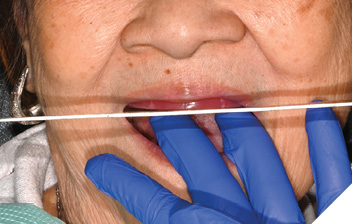 Occlusion rim appointment. 