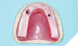 Wax rims with access to the implants. 