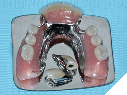 Screw retained crowns with a cast partial denture.