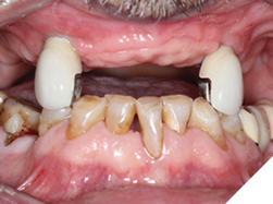 Screw retained crowns inserted with minor occlusal adjustments done.