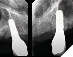 Radiographs to verfiy seating.