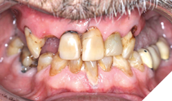 Multiple missing maxillary teeth.