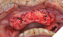 Staged implant placement with GBR, applying Sticky bone protocol. 