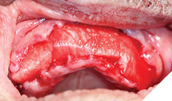 Collagen membranes carefully draped over the alveolus of all areas grafted. 