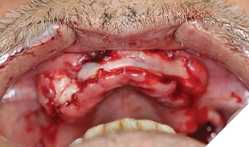 Platelet rich fibrin membranes placed over the collagen membranes. 