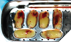 L-PRF membranes derived after a short chairside phlebotomy spin in the centrifuge.