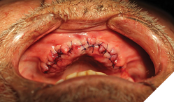  - 5-0 Vicryle Rapide was used to attain primary closure. 