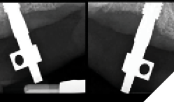Radiographic verification of the impression coping seating.