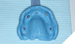 Open tray pick up impression. 