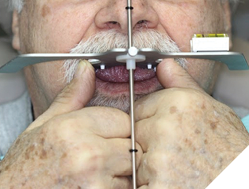 Occlusal plane parallel in relation to the interpupillary line.