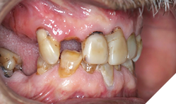 Loss of vertical dimension due to attrition and pathological migration. 