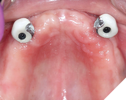 Noted the precision retention slots along the mesial and palatal of the crowns. 