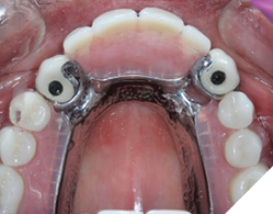 A fully seated partial denture into the precision slots on the crowns 13 and 23.