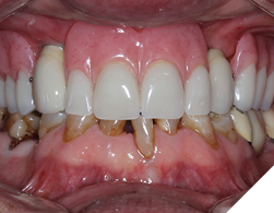 A final full arch maxillary removable prosthesis delivered on 2 screw retained crowns.