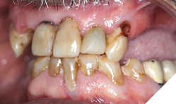 Cervical abrasions due to the clasps from the partial denture
