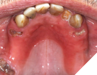 Denture stomatitis from patient not removing partials at bedtime.