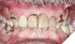 Visible metal clasps in the anterior esthetic zone