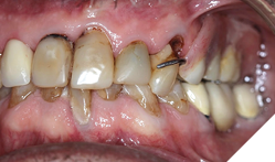 Need for close adaptation to the adjacent teeth causing damage to the CEJ.