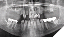 Presence of root stumps and a large endodontic lesion.