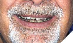 Low smile line showing less than 3mm of tooth display.