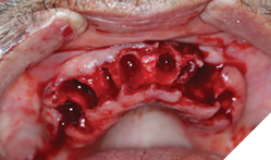 Removal of all maxllary teeth, note loss of buccal plates along the 23 region.