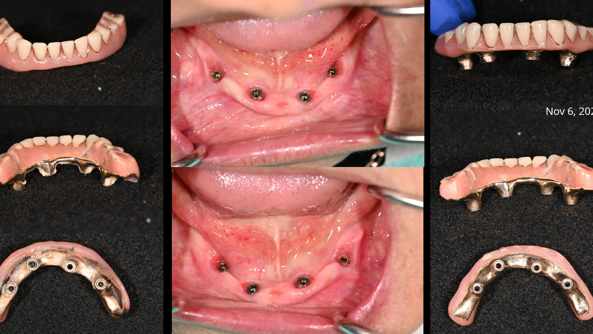 Management of prosthetic complications in hybrid implant-supported