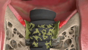 Peri-implantitis with soft tissue degradation, inflammation, significant bone loss, and bacterial colonisation. 