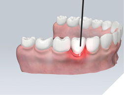 Diffusers radiate laser light precisely and homogeneously for best treatments such as healing gingivitis or preparing root canal treatments. Image: SCHOTT.