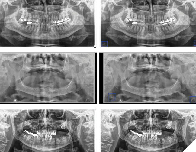 Panoramic radiographs showing three patients with a carotid plaque, without and with AI detection (blue bounding box). 