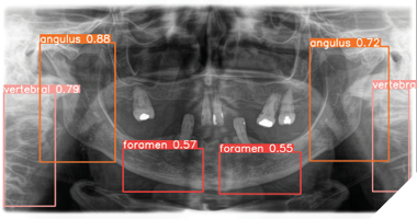 Panoramic radiograph showing the detection of osteoporosis in different regions of the mandible. With the algorithm combining the mental foramen and the cortical paramedian region we reached an 83% sensitivity.

