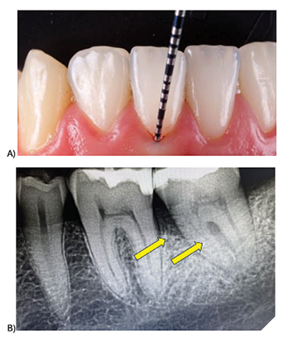 1A. A standard periodontal probe assesses attachment loss and bleeding. 1B. A radiograph taken after the patient reported pain and bleeding gums on tooth 37. The yellow arrows highlight bone loss on the mesial and in the furcation. Periodontal probing and radiographs require significant tissue inflammation, damage and loss to identify disease.