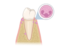  They enter into the periodontal tissues from the blood and exit into the periodontal pocket/crevice, to fight back against the invading bacterial biofilm. As the bacteria invade deeper into the pocket, often due to inadequate hygiene, more neutrophils are required to fight the threat. Increasing neutrophil numbers leads to more inflammation