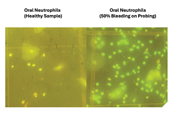 Microscope images of neutrophils in an oral rinse (Bright dots). Note the increased number of cells from mouths with inflammation. To develop a chairside clinical test required a biochemical test to be developed.