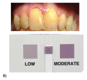 Perio Monitor test = MODERATE color = elevated level of oral inflammation ‘Moderate’ level is associated with a high concentration of neutrophils. Full mouth charting revealed 6 sites with >5 mm pockets and 30 sites with BOP (consistent with the medium result). This test was used to educate the patient. The patient understood the test result using overall health terms and accepted the probing procedure and treatment recommendations.