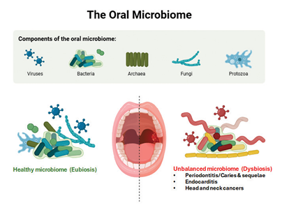 Microbial dysbiosis leads to oral diseases such as dental caries and periodontal diseases, heart diseases and cancers. Created with BioRender.com.