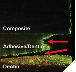 Compromised interface: A confocal scanning laser microscopy reconstructed image of an in vitro dentin-adhesive-resin composite interface, with S. mutans cells visible as small dots (green = live, yellow/red = dead) [9]. The adhesive interface has been significantly degraded, allowing bacteria to penetrate.