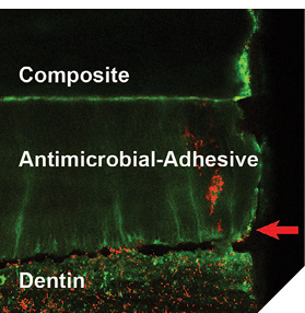 Protected Interface: A confocal scanning laser microscopy reconstructed image of an in vitro dentin-antimicrobial silica enabled adhesive-resin composite interface, with S. mutans cells visible as small dots (green = live, yellow/red = dead) [9]. Even after significant microbiological challenge the restoration interface is largely intact (red arrow), with most cells visible dead (red).