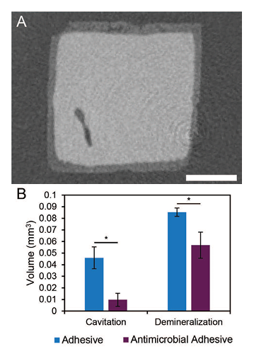 Cavitation and demineralization: A) A micro-CT cross-section of an in vitro resin composite-adhesive-dentin specimen demonstrating significant demineralization (light grey areas) at its perimeter after 1-week incubation in a cariogenic dual-species biofilm (scale bar = 1 mm). B) Quantitative analysis of specimen demineralization and cavitation from the same study as A), demonstrating the significant effects of Mesosil’s additive on secondary caries prevention [9]. 