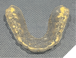  Significant wear and built-up on clear removable retainer. 