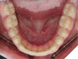 A well maintained lower 3-3 bonded permanent retainer. 