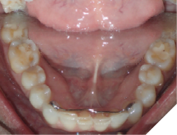 A poorly maintained lower 3-3 lingual bar.