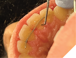 Checking the bonding resin for movement.