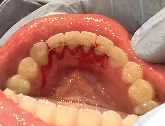 Bleeding upon probing. 