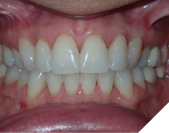 58-year-old female patient who
received orthodontic treatment 20
years ago. She still has the original
well-maintained upper 2-2 and lower
3-3 bonded permanent retainers. She
was referred by her dentist to increase
the thickness of the orthodontic
resin.